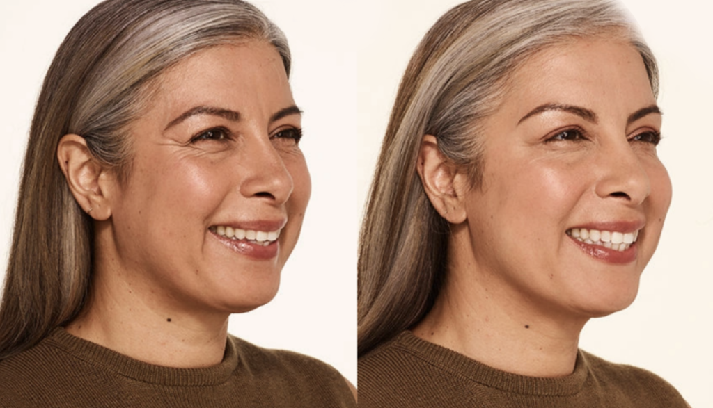 Botox & Dermal Fillers before-after