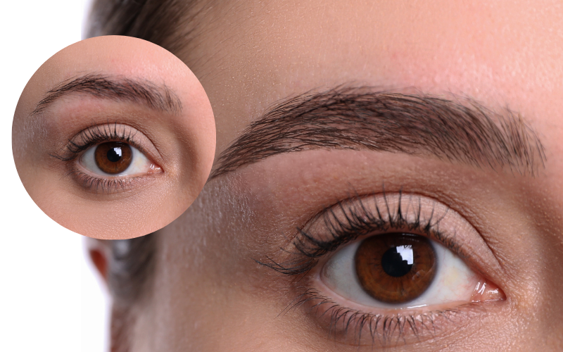 Cosmetic Eyebrow & Forehead lifts 3