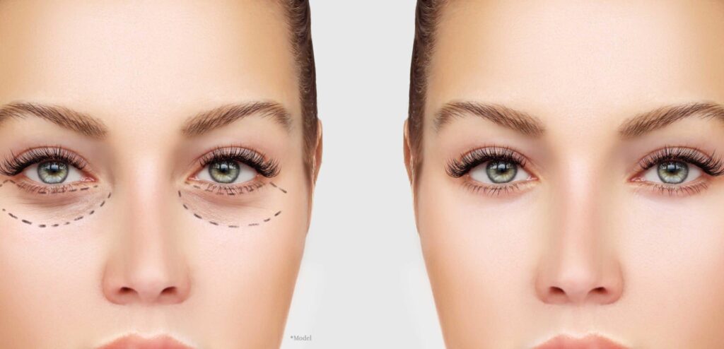 Cosmetic
Blepharoplasty 2